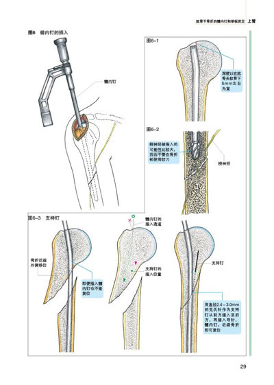 日本骨科新标准手术图谱:上肢骨折?脱位(手术